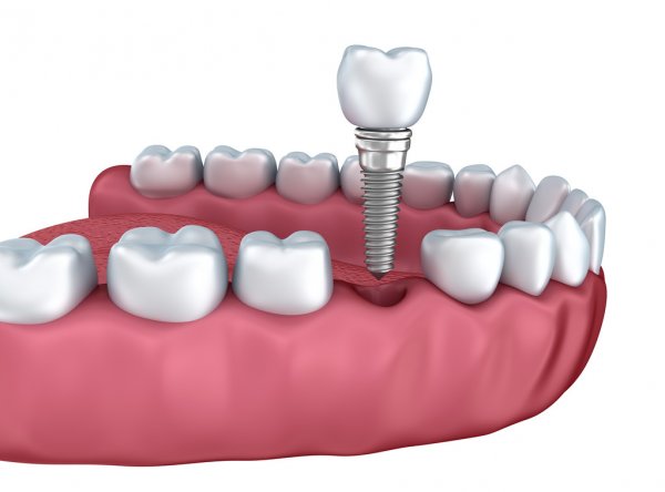 dentist in Janakpuri for Dental Implant