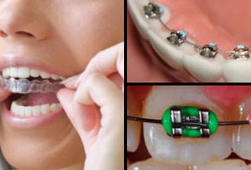 Cosmetic Dentistry Invisalign Braces