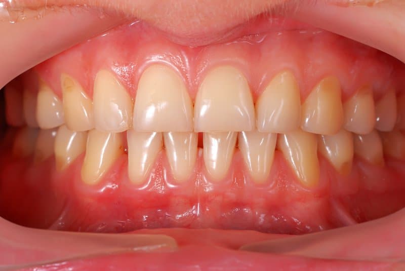 Gum Disease