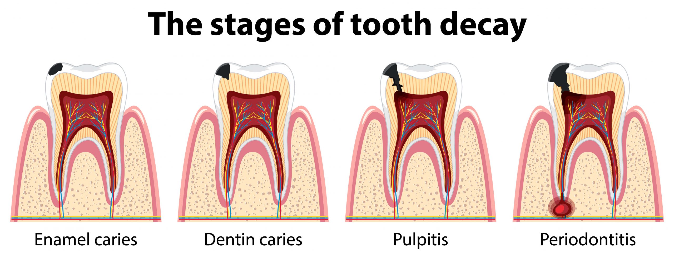 Gum Diseases