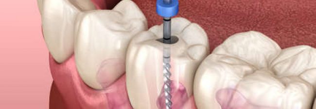 Endodontic-Root-Canal-Treatment